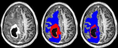 Classifying Glioblastoma Multiforme Follow-Up Progressive vs. Responsive Forms Using Multi-Parametric MRI Features